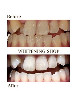 ホワイトニングショップ 徳島藍住店/Before After美白ホワイトニング