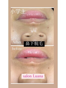 ルアナ(Luana)/キッズ口周り脱毛!