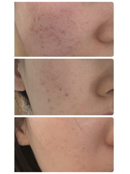 ル シェリア(Le Cherien)/マイクロニードル100万本