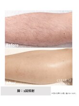 フィルムス(FILMS.)/足脱毛のBeforeAfter