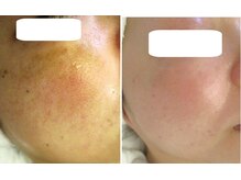 サロンドエステケイワイ(de KY)/フェイシャル☆濃いシミ改善