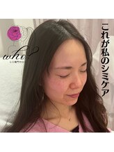 フー(Who?)/これが私のシミケア