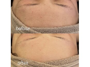 リノ(Lino)/プラズマbefore after