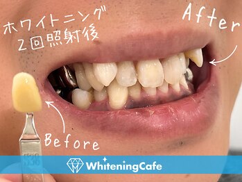 ホワイトニングカフェ 白山店(WhiteningCafe)/◎歯のホワイトニング施術写真◎