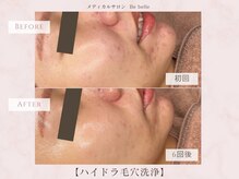 ビベル 八木店(Bebelle)/繰り返す大人ニキビの改善