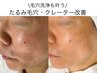  人気No1《ニキビ・肌の凹凸跡》ピーリングで毛穴も改善/ 男性にも◎/越谷