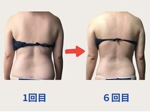 ネオボディ(Neo Body)の雰囲気（施術6回目！自分ではケアが難しい腰回り&背中もスッキリ◎）