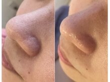 ミュレア 新宿本店(mulea)/【ハイドラ＋ アクアダーマ】