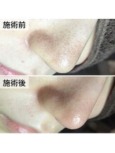 美鼻ラボ 押上 曳舟/毛穴の詰まりもお任せ！