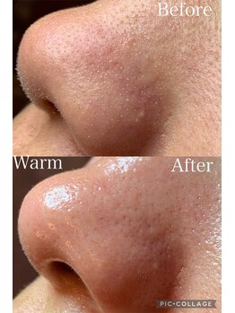 ウォーム(Warm)/20代女性毛穴エクストラクション