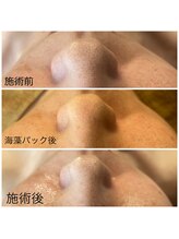 ビューティースタジオ ハンミ 福岡大名店(Beauty studio 韓美)/毛穴吸引