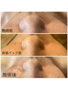 ビューティースタジオ ハンミ 福岡大名店(Beauty studio 韓美)/毛穴吸引