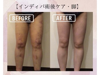 オキシー グレイス 小倉店(OXY Grace)/【インディバ術後ケア・脚】