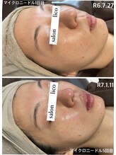 リコ(Lico)/リフトアップケア