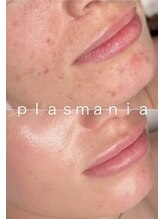 オリエンタルビューティー(ORIENTAL BEAUTY)/プラズマフェイシャル