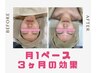 【水光フォト×幹細胞導入】白玉肌管理1番人気！！ ¥6000