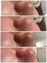 ネムレル森(Nemureru森)/毛穴洗浄【水巻/八幡西区/折尾】