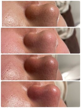 ネムレル森(Nemureru森)/毛穴洗浄【水巻/八幡西区/折尾】