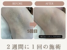 シルク(Cilk)/ワキ脱毛