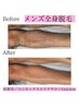 【メンズ脱毛】全身脱毛（顔・VIOなし）10回　￥363,000→￥253,000