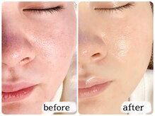 カピリナスパ(Ka.Pilina Spa)/毛穴洗浄★　before⇒after