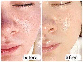 カピリナスパ(Ka.Pilina Spa)/毛穴洗浄★ before⇒after