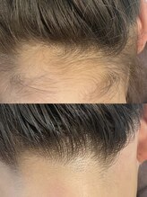 シューティングハーツ(SHOOTING HEARTS)/うなじ脱毛