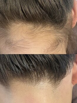 シューティングハーツ(SHOOTING HEARTS)/うなじ脱毛