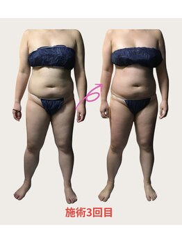 ネオボディ(Neo Body)/サイズダウン