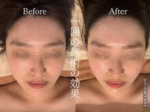 ラムール(L'amour)/コルギ×ハーブピーリング＝最強