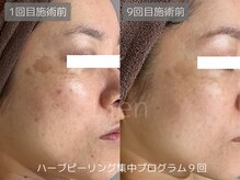 リアン/ハーブピーリング集中プログラム