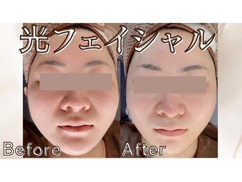 アイビ(愛美)の写真/美白ケアで自信UP！明るく透明感のある肌へ導き、内側からふっくらとした輝く素肌を体験しませんか？◎