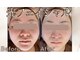 アイビ(愛美)の写真/美白ケアで自信UP！明るく透明感のある肌へ導き、内側からふっくらとした輝く素肌を体験しませんか？◎