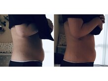 ティアラ(tiara)/下腹集中！1回before→after