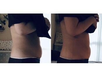 ティアラ(tiara)/下腹集中！1回before→after