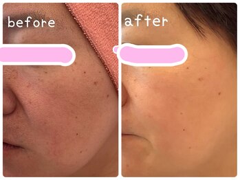 ヒメミ(Himemi)/BBL光エステ