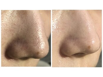 ヴィエルージュ(Vierouge)/ハイドラフェイシャルピーリング