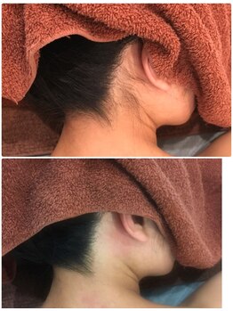 叶(Kanau)/【脱毛】全身脱毛、部分脱毛あり