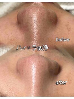 優来 神田店/毛穴洗浄