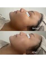 ラリュンヌ(La Lune)/たるみ/リフトアップ/小顔