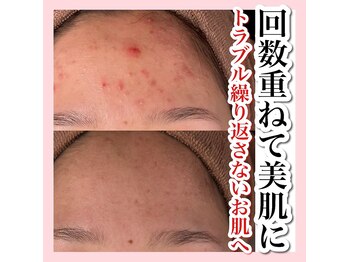 アルムダアクア 天王寺店(Aleumda AQUA)/ハーブピーリング/大阪/天王寺