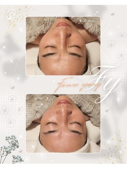 ハレル(Hareru)/Before…After(16)FOREVER YOUNG