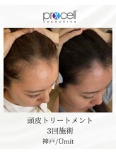 ユミト(Umit)/プロセルスカルプ