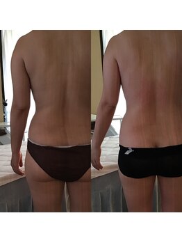 ティアラ(tiara)/ハミ肉集中！1回before→after