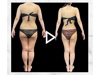 エステティック エイチアンドビー 大和店(H&B)/ビフォーアフター