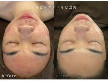 オヤム(oyam)/《ハーブピーリング》