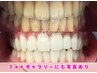 【再来３照射】もう少しトーンアップ★プラチナムホワイトニング15分×3照射