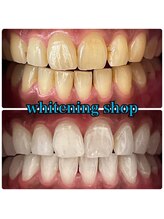 ホワイトニングショップ 大阪玉造店/Before&After美白ホワイトニング