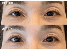 まぶたの間/若々しい見た目を目指す方に