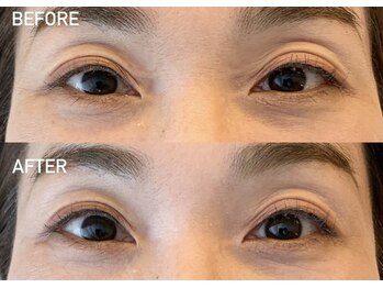 まぶたの間/若々しい見た目を目指す方に